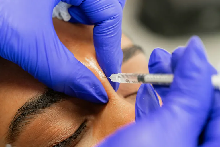 A gloved injector steadying the skin between the eyebrows while placing an injection with a fine-gauge syringe