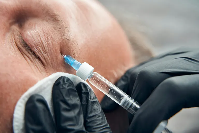 A close-up of an injection at the outer corner of the eye, with lateral canthal lines visible in the skin beside it