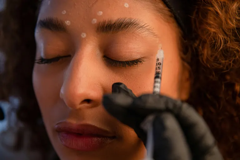 An injector treating the forehead, with the injection points marked out across the frontalis and between the brows before any product is given