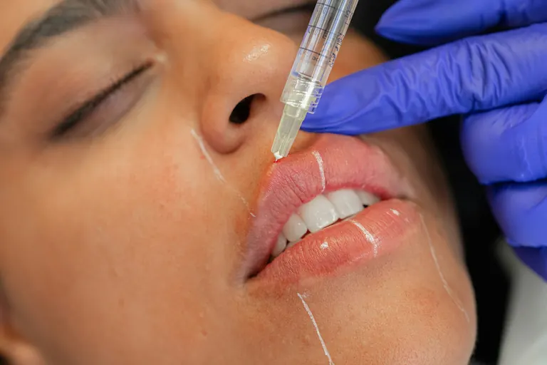 A fine-gauge needle held at the border of the upper lip, with guide lines marked on the skin around the mouth