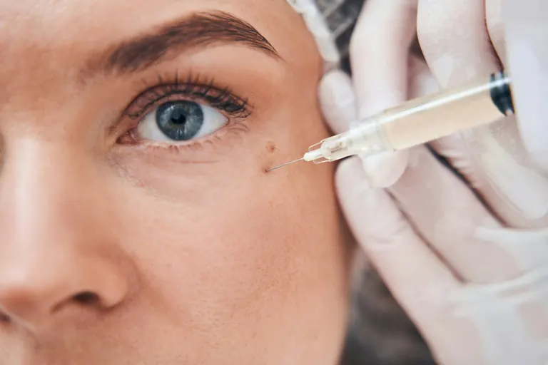 A close-up of a syringe held beside the lower eyelid and outer eye area of a patient with visible fine lines