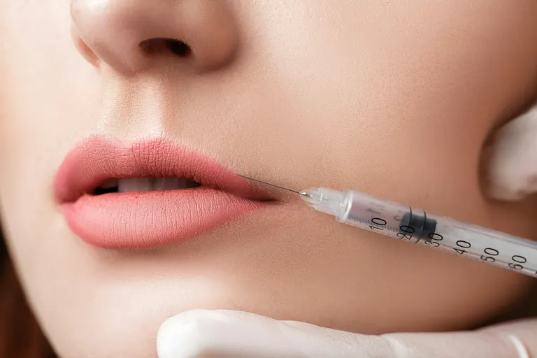 A close-up of a syringe being injected into the border of a patient’s upper lip