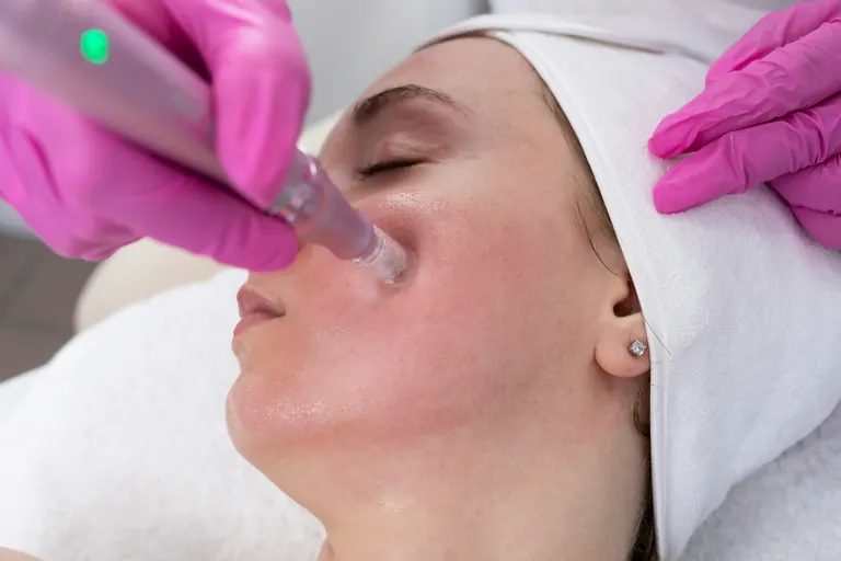 A practitioner using a microneedling pen on a patient's cheek