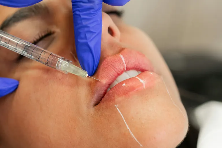 A fine-gauge graduated syringe held at the outer corner of the mouth, with white marker guide lines drawn on the surrounding skin