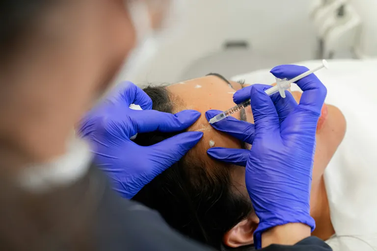 A gloved clinician injecting the forehead with a graduated syringe, with white marker dots visible across the treatment area
