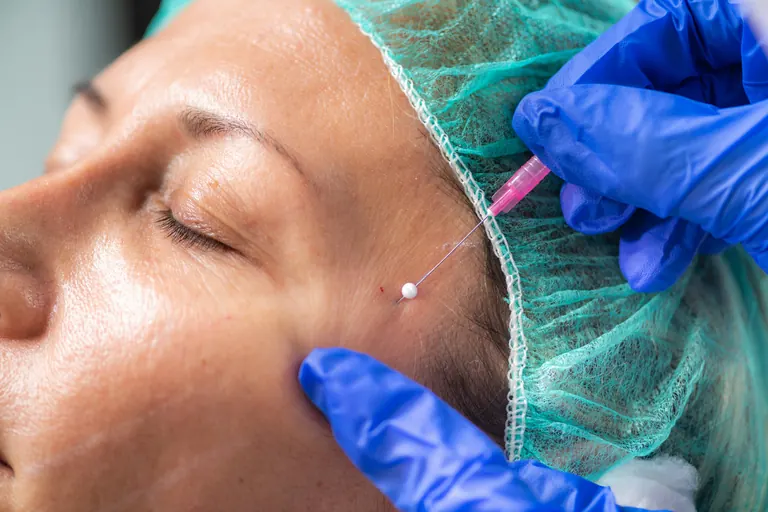 A fine needle entering the skin at the outer brow, held by a gloved injector, with a small spot of blood at the entry point