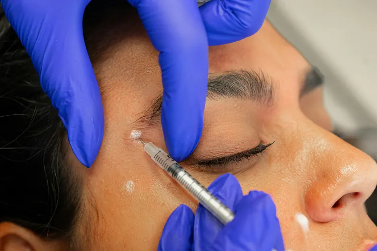 A gloved injector steadying the skin at the tail of the eyebrow while placing an injection with a graduated syringe, with small white marker dots visible on the skin